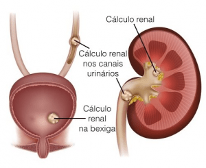 Ureterolitotripsia - Clínica Dr. Raphael Farias - Urologia